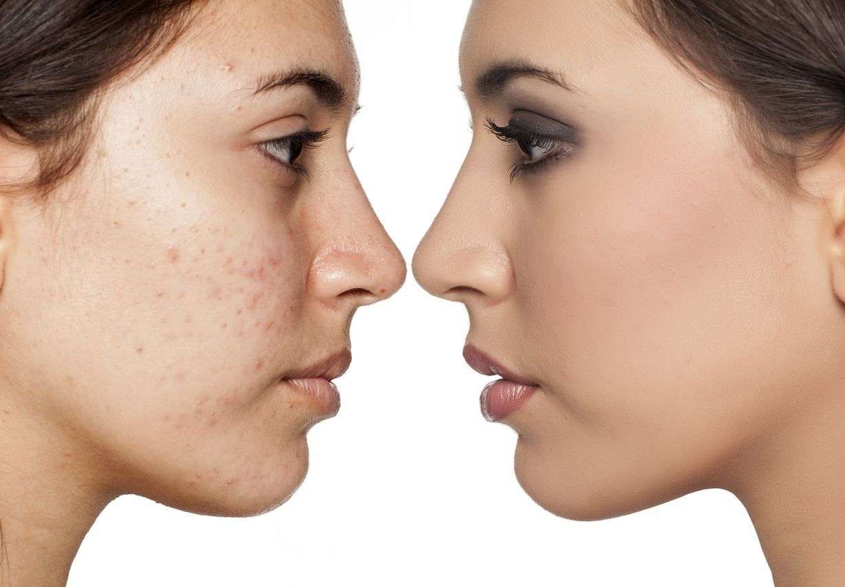 Ayurveda for Acne