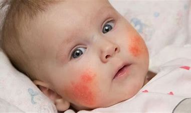 Eczema or Atopic Dermatitis : Symptoms,Treatment - Dr.Garima