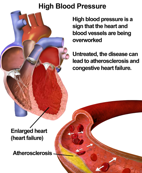 HYPERTENSION [High Blood Pressure]