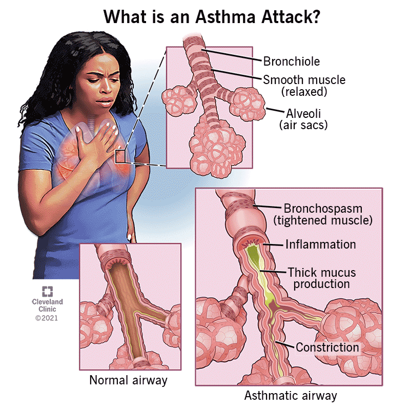 Asthma worsens during winter