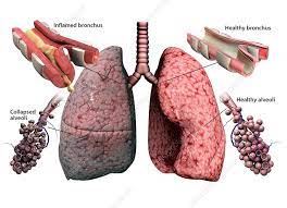 COPD and related issues